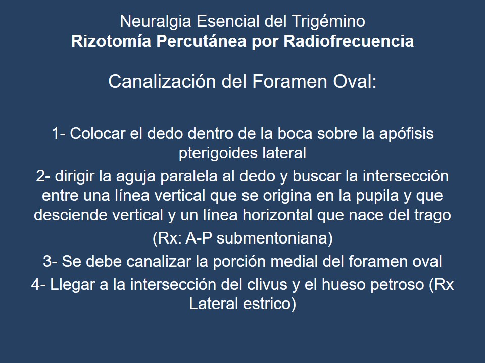 Neuralgia Esencial del Trigémino - Dr Guillermo Larrarte